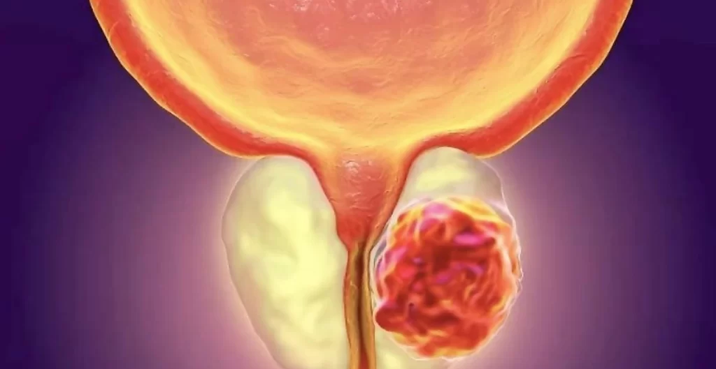 Adenomul de prostată, o afecțiune frecventă la bărbații de peste 60 de ani